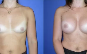 Antes y después de aumento de senos