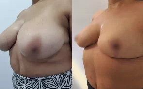 Antes y después de reducción de senos