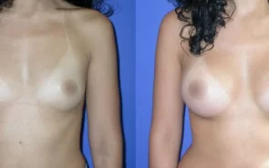 Cirugía aumento de senos