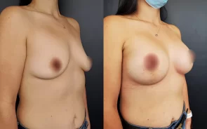 Resultado cirugía mamoplastia de aumento
